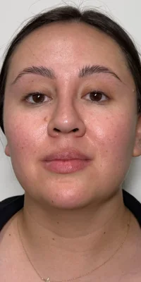 Before: CO2 Laser