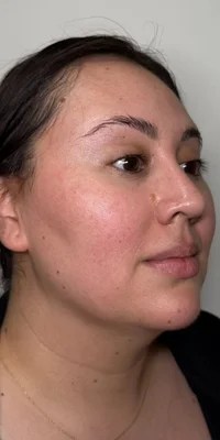 Before: CO2 Laser