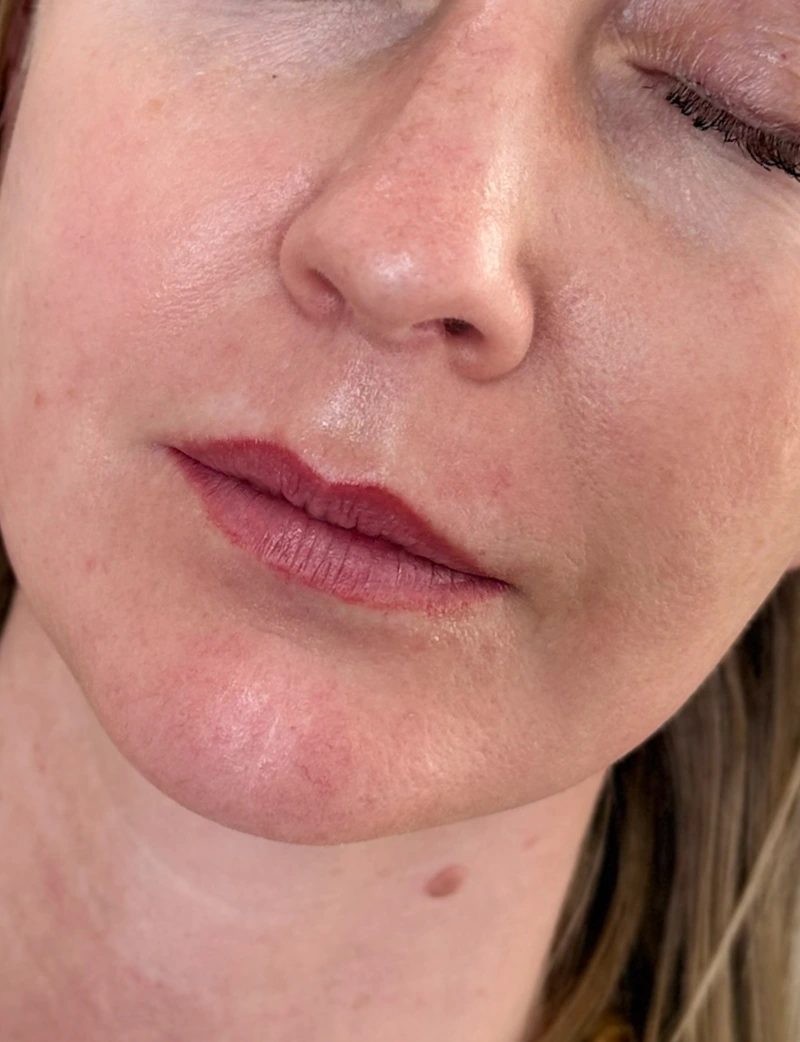 Before: Lip Filler - 1 syringe