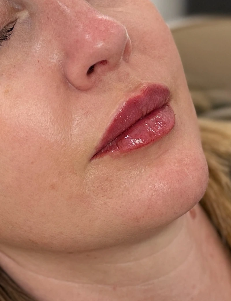 After: Lip Filler - 1 syringe