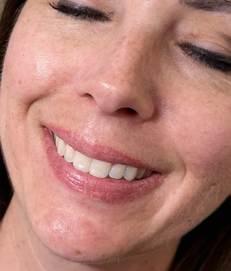 Before: Lip Filler - 1 syringe