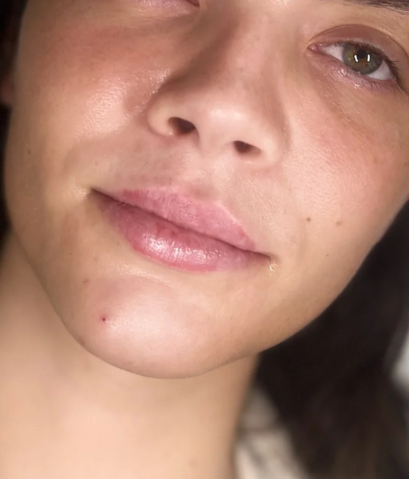 Before: Lip Filler - 0.5 syringe