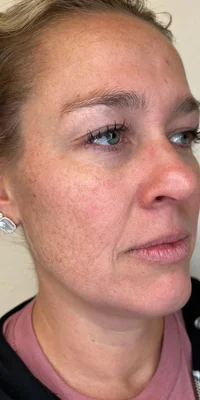 Before: ZO Skin Health