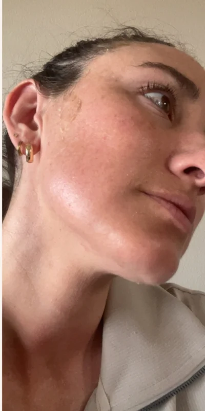 After: Retinol and targeted interventions for clear skin